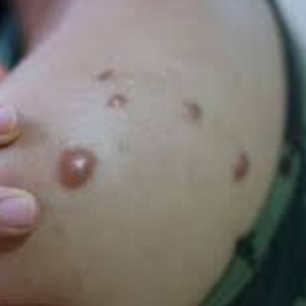 Kenali penyakit cacar monyet beserta cara penularannya. Foto: Open Access Government