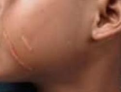 Viral! Oknum Kepala Sekolah di Blora Diduga Cakar Siswa SD Hingga Luka, Netizen Geram: “Guru Itu Digugu lan Ditiru!”