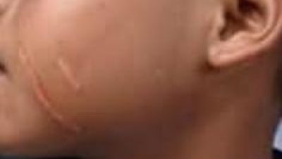 Viral! Oknum Kepala Sekolah di Blora Diduga Cakar Siswa SD Hingga Luka, Netizen Geram: “Guru Itu Digugu lan Ditiru!”