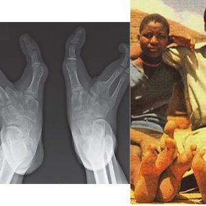 Mengenal Suku Vadoma di Afrika yang Punya Sindrom Kaki Burung Unta