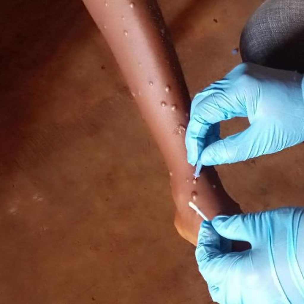 Mengenal tentang wabah Mpox. Foto: news.un.org