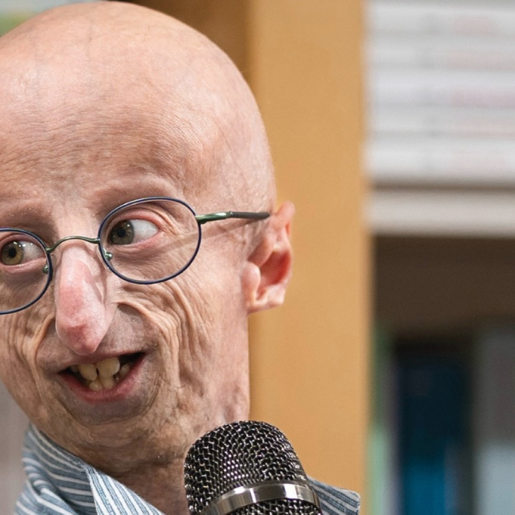 TUTURPEDIA - Penyintas Penyakit Langka Sammy Basso Tutup Usia di 28 Tahun, Apa Itu Progeria?