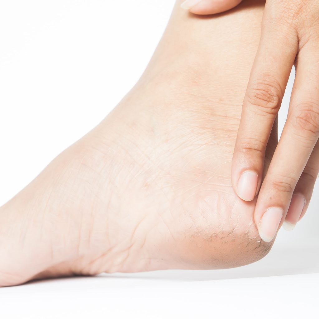 Kulit tumit kaki yang kering bisa sebabkan pecah-pecah, simak cara perawatannya. FOTO: Freepik.com/schantalao