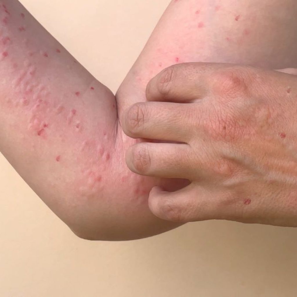 Kemenkes sediakan 4.450 dosis vaksin dan 12 laboratorium untuk cegah penyebaran mpox. Foto: sehatnegeriku.kemkes.go.id