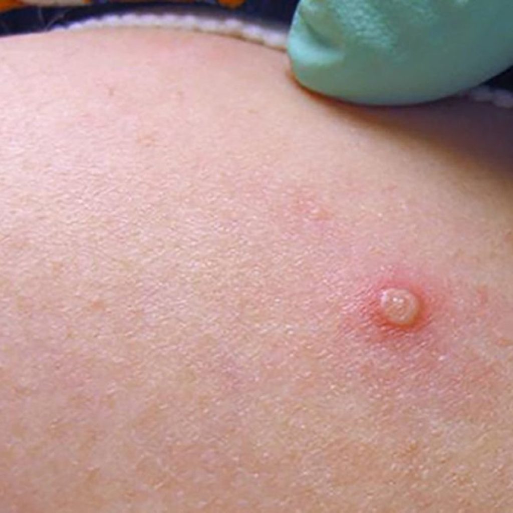 Ingatkan Mpox Varian Clade Ib yang Bisa Menular Lebih Cepat, BRIN: Wajib Disiplin Protokol Kesehatan!