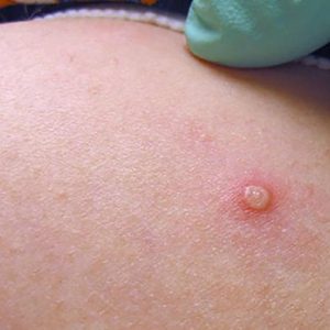 Ingatkan Mpox Varian Clade Ib yang Bisa Menular Lebih Cepat, BRIN: Wajib Disiplin Protokol Kesehatan!